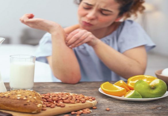 5 أطعمة تسبب الحساسية لمصابين التهاب الجلد التأتبي 5 أطعمة تسبب الحساسية لمصابين التهاب الجلد التأتبي