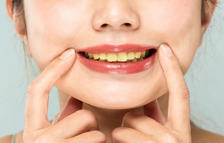 10 أسباب رئيسية تؤدي لحدوث إصفرار الأسنان