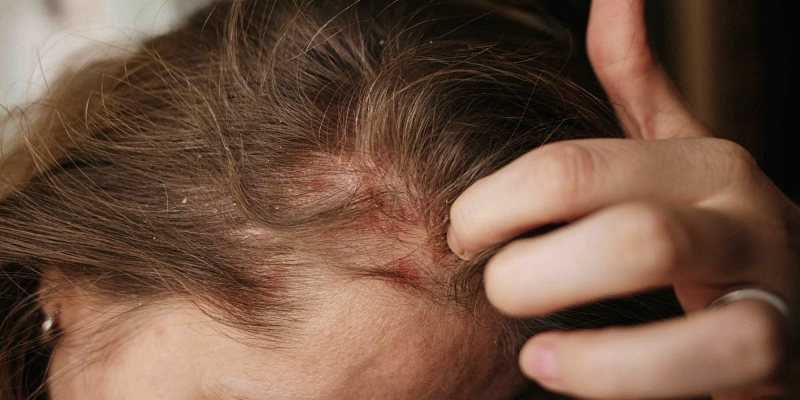 النتائج السلبية المترتبة على عملية زراعة الشعر