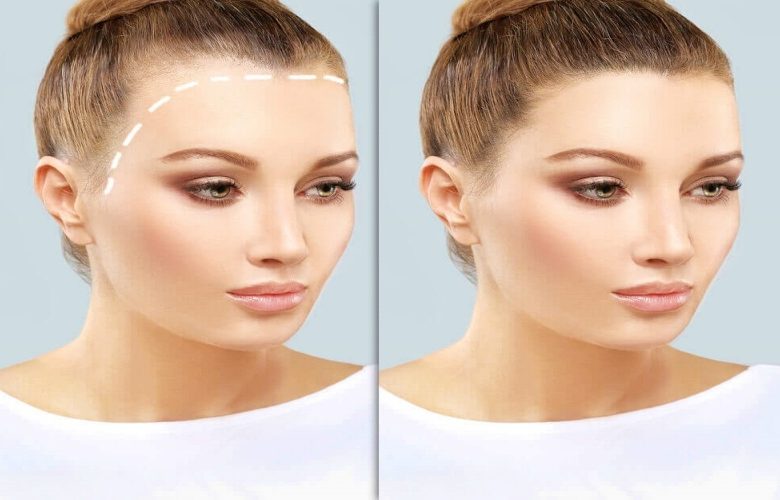 عملية زراعة الشعر وأهم الآثار السلبية الناتجة عنها