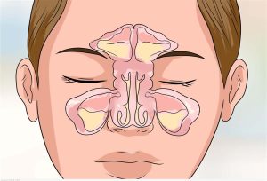 تفسير آلام  مقبس العين الناجم عن التهاب الجيوب الأنفية