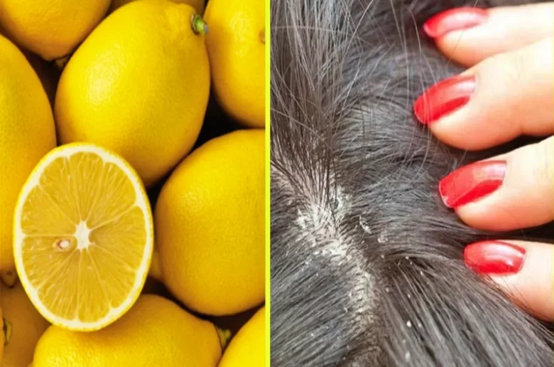 4 طرق فعالة وسريعة لعلاج فطريات فروة الرأس بالليمون