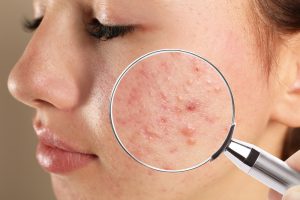 كيف تؤثر الدورة الشهرية على صحة الجلد؟