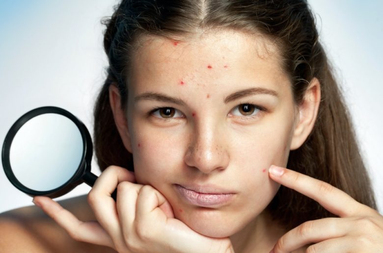 كيف تؤثر الدورة الشهرية على صحة  الجلد؟