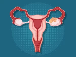 متلازمة المبيض المتعدد الكيسات (PCOS)