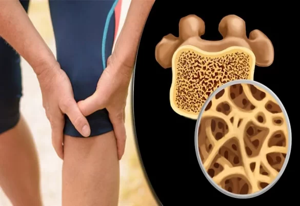هشاشة العظام في الركبة وكيف نستطيع التعامل مع هذا الأمر؟ هشاشة العظام في الركبة وكيف نستطيع التعامل مع هذا الأمر؟
