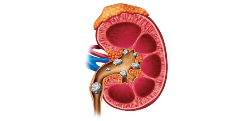 الإصابة بحصوات الكلى