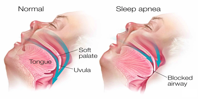متلازمة توقف التنفس أثناء النوم