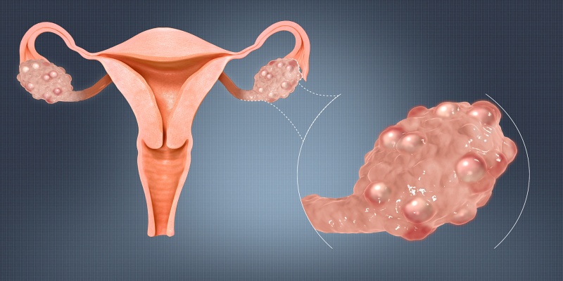 متلازمة المبيض المتعدد الكيسات (PCOS)