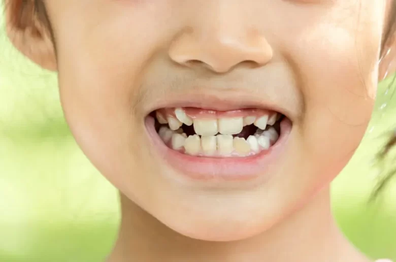إعوجاج الأسنان عند الأطفال إعوجاج الأسنان عند الأطفال