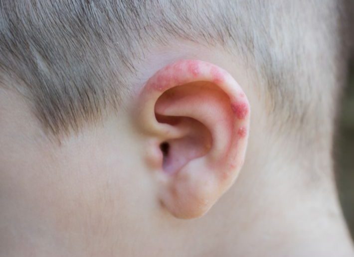 إكزيما الأذن إكزيما الأذن