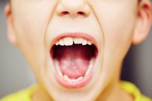اعوجاج الأسنان عند الأطفال