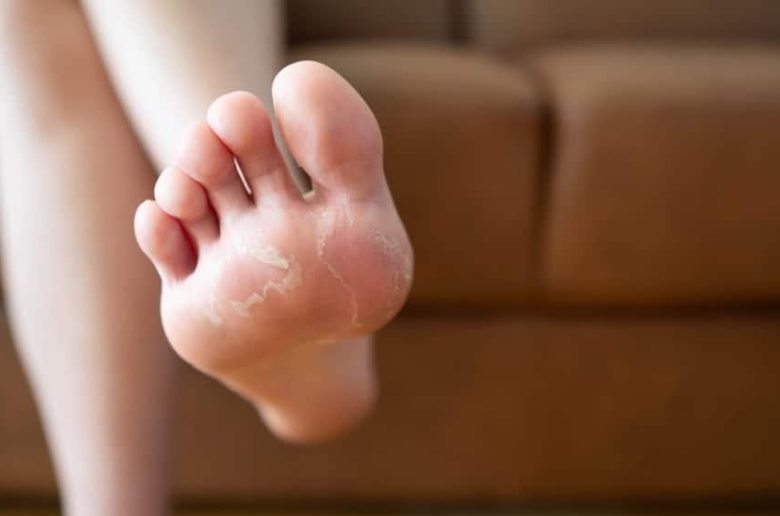 القشور الجلدية البيضاء على القدمين