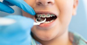 طرق علاج الأسنان الملتوية