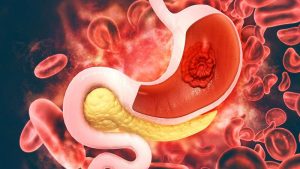 نزيف الجهاز الهضمي