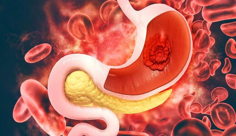 نزيف الجهاز الهضمي