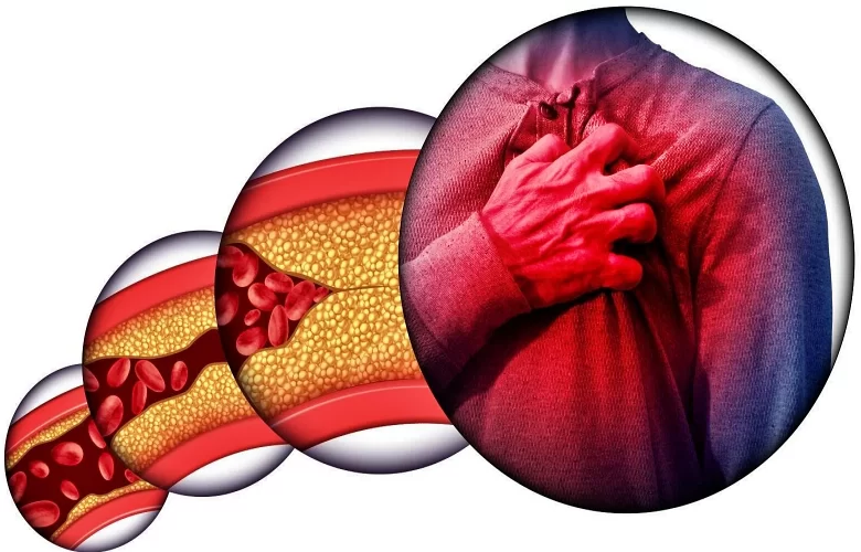 ما هي أهم المضاعفات التي يمكن أن تسببها الدهون المرتفعة في الدم؟ ما هي أهم المضاعفات التي يمكن أن تسببها الدهون المرتفعة في الدم؟