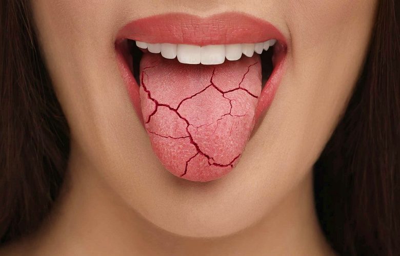 طرق علاج جفاف الفم بشكل فعال داخل المنزل