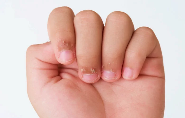 الجلد الميت حول أصابع اليدين .. طرق فعالة للتخلص منه