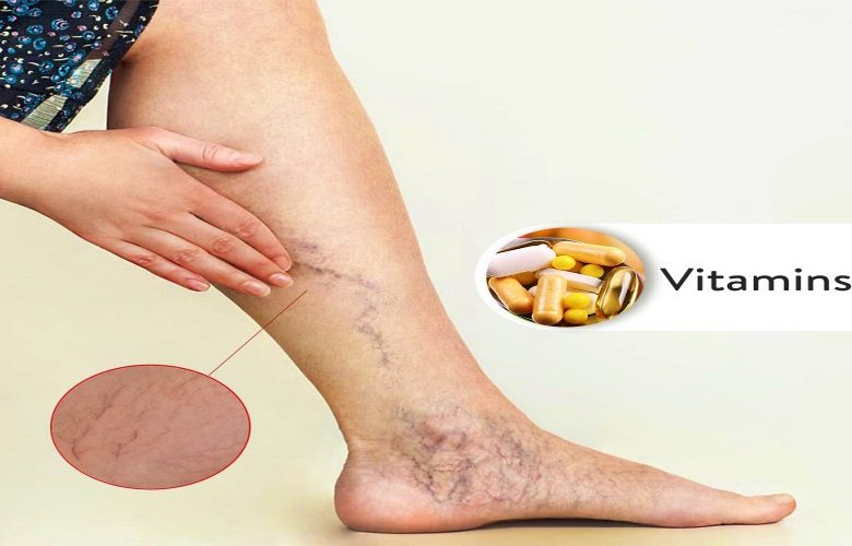 نوعان من الفيتامينات عند نقصانهما تحدث المعاناة من الدوالي