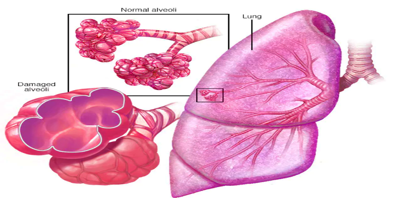 مرض الانسداد الرئوي المزمن (COPD)