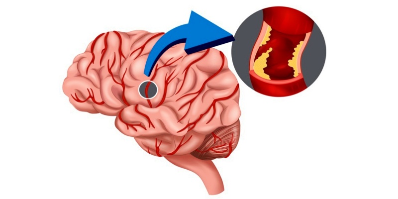 قصور الدورة الدموية الدماغية
