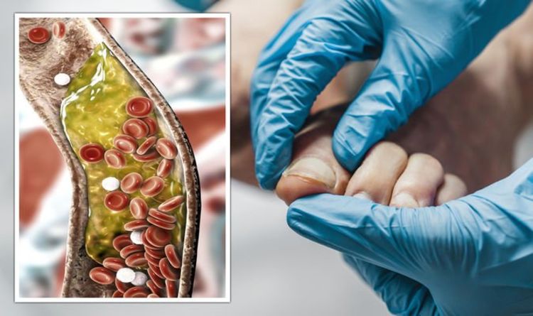 أعراض ارتفاع نسبة الكوليسترول على الأصابع