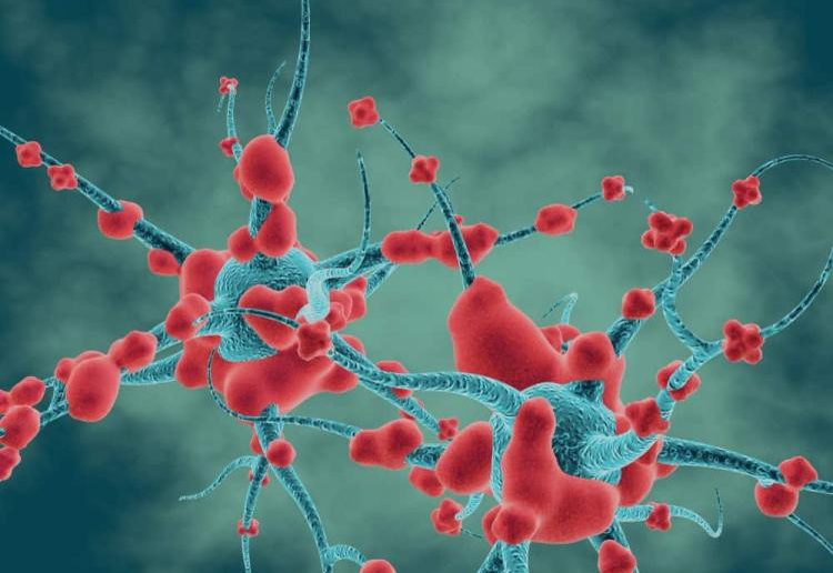 التهاب الأعصاب