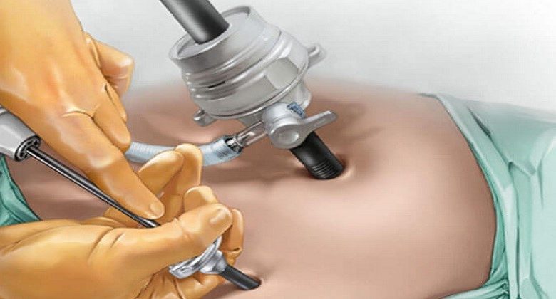 الجراحة بالمنظار لتكيسات المبايض