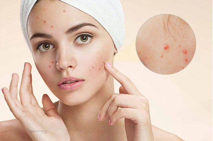العلاقة بين بثور الوجه ومواقع ظهورها