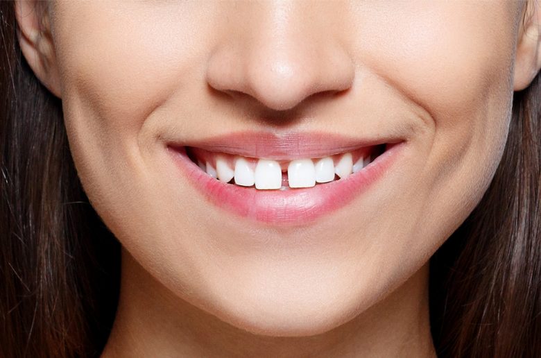 فراغات الأسنان