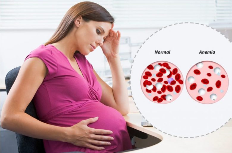 أبرز مضاعفات الأنيميا على السيدات الحوامل
