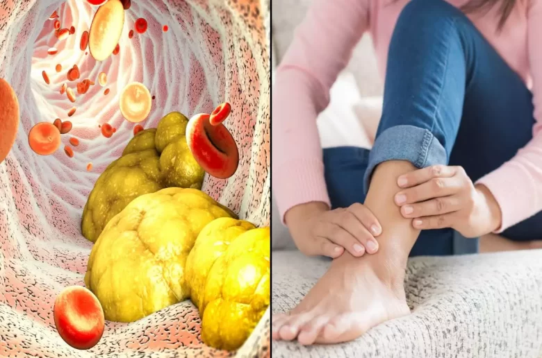 هل يسبب فرط الكوليسترول تشنجات مؤلمة في العظام ؟