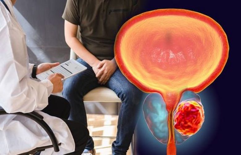 الأورام الليفية في البروستاتا وكيف نستطيع التعرف عليها؟