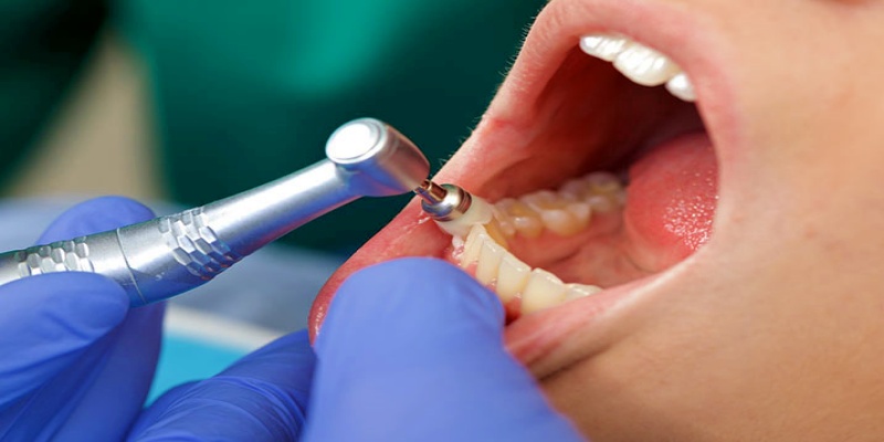 الآلية الآمنة لممارسة روتين إزالة جير الأسنان بشكل دوري مستمر