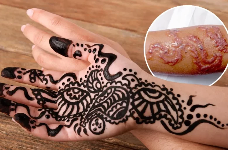 أضرار شائعة لتطبيق الحنة السوداء على الجلد والأظافر أضرار شائعة لتطبيق الحنة السوداء على الجلد والأظافر