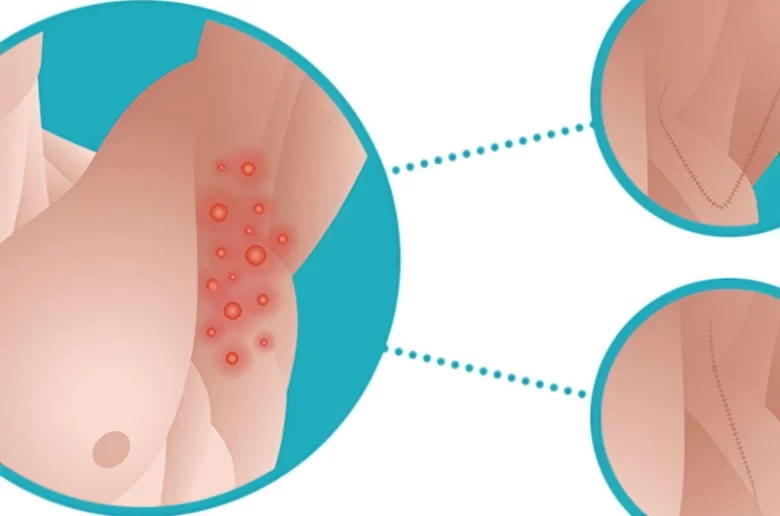 التهاب الغدد العرقية