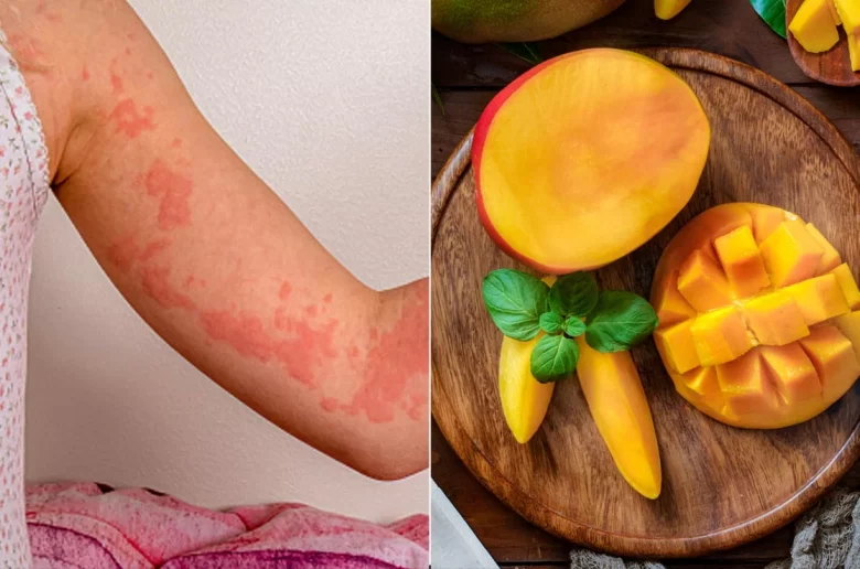 حساسية المانجو