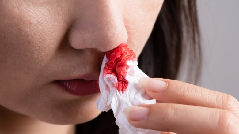 مخاط الأنف الدموي في فصل الصيف