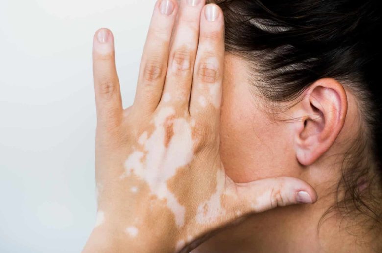 مشكلات جلدية تسبب تغيرات في لون الجلد مشكلات جلدية تسبب تغيرات في لون الجلد