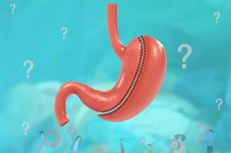 نصائح فعالة قبل عملية تكميم المعدة نصائح فعالة قبل عملية تكميم المعدة