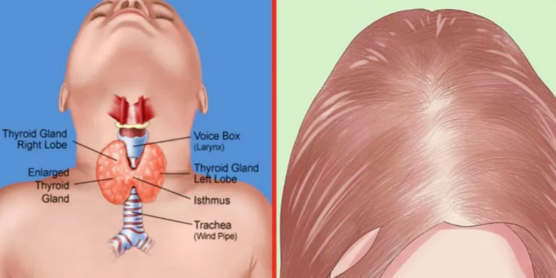 أمراض الغدة الدرقية وتساقط الشعر