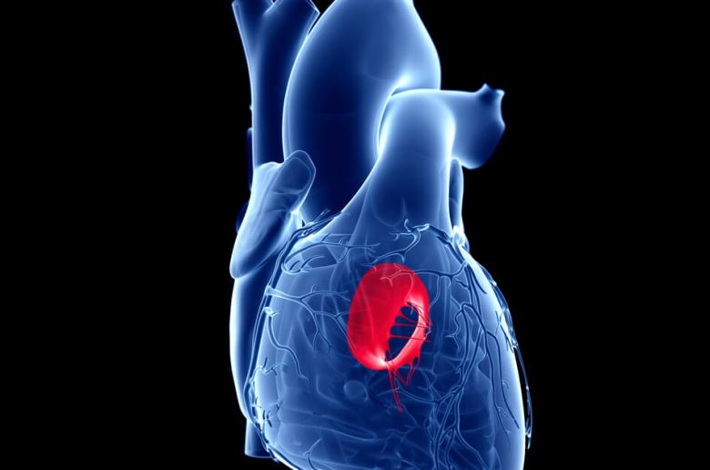 ارتخاء الصمام الميترالي ارتخاء الصمام الميترالي