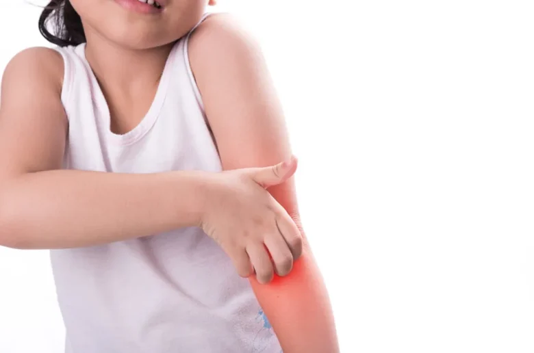 الإكزيما لدى الأطفال الإكزيما لدى الأطفال