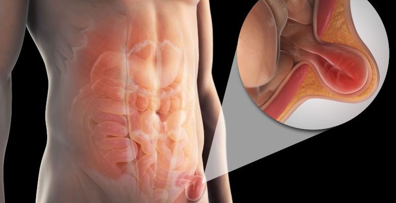 الفتق الأربي