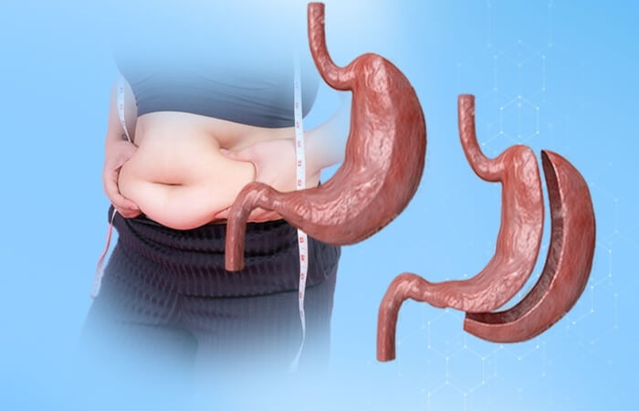 حالات مرضية ممنوعة من إجراء عملية تكميم المعدة