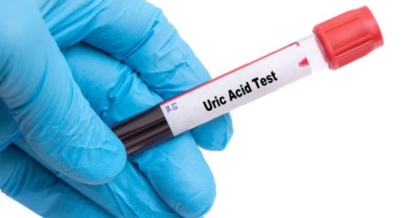 فحوصات فعالة لمرضى النقرس
