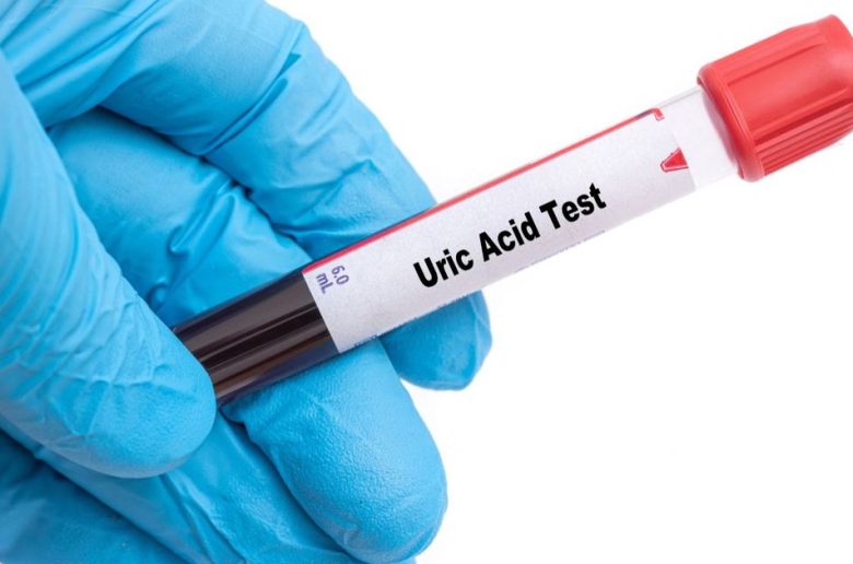فحوصات فعالة لمرضى النقرس