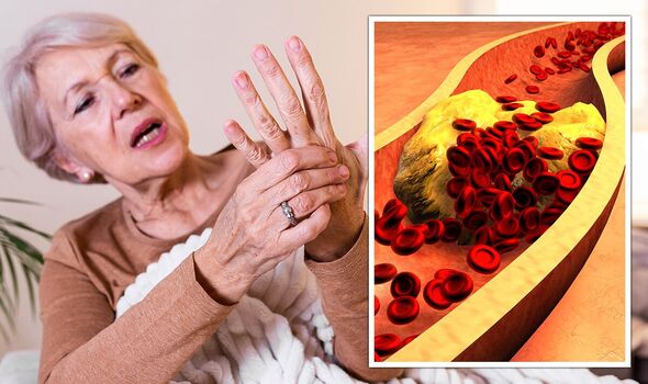 فرط الكوليسترول لدى النساء بعد سن الخمسين