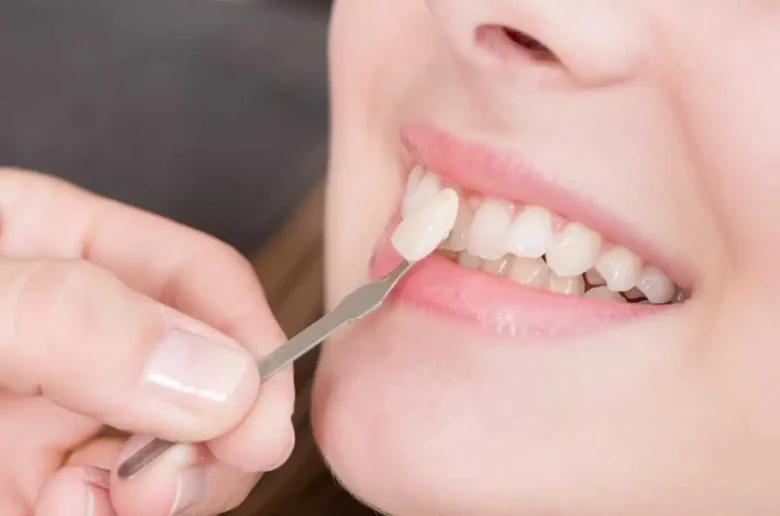 فينير الأسنان فينير الأسنان